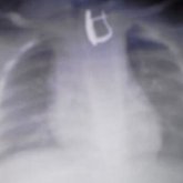 Алматыда дәрігерлер сырға жұтып қойған 5 айлық баланы құтқарды