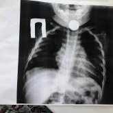 Ақтауда бір жарым жасар сәбидің өңешінен 10 теңгелік монета шықты