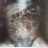 Шеге жұтып қойған 4 айлық сәби тірі қалды