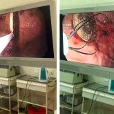 6 жасар баланың асқазанынан 100 теңге шықты