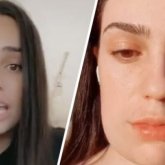 Бетіне екпе салдыртқан қыз адам танымастай өзгеріп кетті