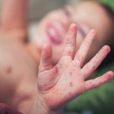 «Мультисистемалық Кавасаки ауруы балалар үшін өте қауіпті болуы мүмкін» - профессор