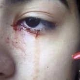 Асқазаны ауырған қыздың көзінен қан ақты