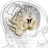 Ғалымдар депрессиямен күресуге арналған ми имплантын ойлап тапты