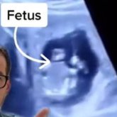 Дәрігер жүкті әйелдің бауырына біткен баланы анықтаған