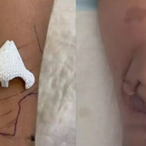 Бетінің бір бөлігінен айырылған әйел хирургтардың көмегімен қолына мұрын салғызды