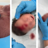 «Бұл не деген жабайы ем?!»: Әлеуметтік желіде балаға хиджама жасаған бейнежазба көптің шамына тиді