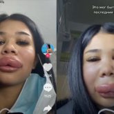 Астаналық ару ернінің пішінін түзетемін деп ауруханадан бір шыққан