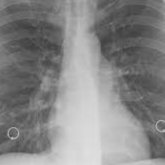 Петропавлда балабақша қызметкерінен туберкулез анықталды