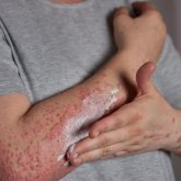 ДСМ: Елімізде псориазды емдеу үшін дәрі-дәрмек тегін беріледі