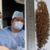 «Өмірде бір-ақ рет кездесетін жағдай»: Алматылық дәрігерлер науқастың өт қабынан 5 мыңнан аса тас алып шықты