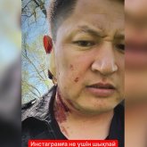 «Мен бұны жәй қалдырмаймын»: Желіде әзілкеш Нұрболхан Шараповтың қан-жоса болған суреті таралды
