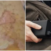 «Ауыр күйік алды»: Алматыда жасөспірімнің қалтасындағы пауэрбанк жарылып кеткен