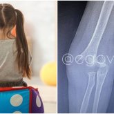 «Бейнебақылау камералары жоқ»: Алматыдағы балалар орталығында ерекше қыздың қолы сынған