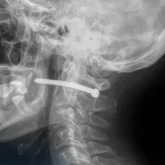 Петропавл тұрғыны мойнына шеге қадап алған