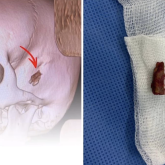 10 жастағы баланың басынан 5 жыл бұрын кіріп кеткен бұтақтың бір бөлігі алынды