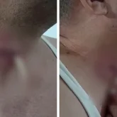 Ақтөбеде ота жасатқан ер адамның мойнында дәке қалып кеткен