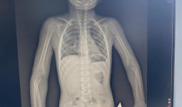 «Кешірім де сұрамады»: Көкшетауда бүлдіршін тісін емдетемін деп оқыс жағдайға ұшырады