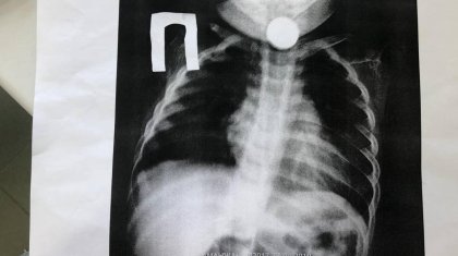 Ақтауда бір жарым жасар сәбидің өңешінен 10 теңгелік монета шықты