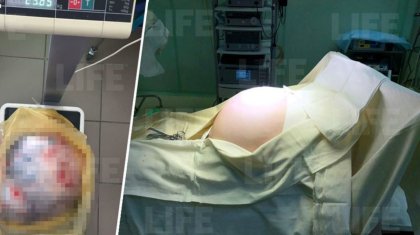 59 жастағы әйелдің қарнынан 25 келі ісік алынып тасталды