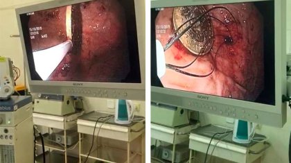 6 жасар баланың асқазанынан 100 теңге шықты