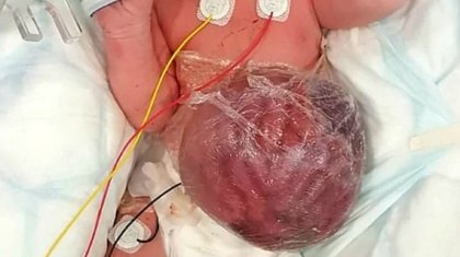 Ағзалары дене сыртында орналасқан қыз екі жасқа толды