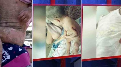 «Балық қыз»: Шиеліде терісі тілініп, қабыршақтанып кеткен 2 жасар қыздың анасы жұрттан көмек сұрады (ВИДЕО)