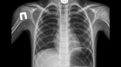 Таразда 9 жасар бала байқамай тиын жұтып қойған (ФОТО)