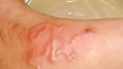 Орал тұрғынының терісінен паразит құрт шықты