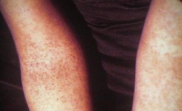 Денге безгегінен 26 адам қайтыс болды