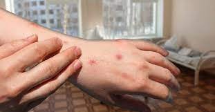 Петропавлда Ұлттық ұлан курсанттары жаппай қызылша жұқтырды