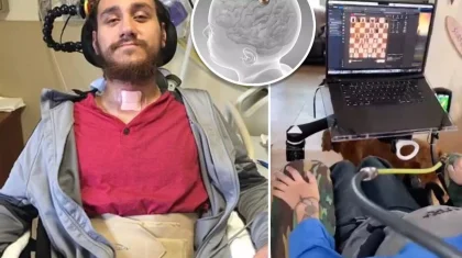 Миына Илон Масктың чипін салдырған адам өмірінің қалай өзгергенін айтты