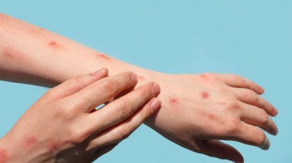 Астана әуежайында жолаушыдан маймыл шешегі анықталғаны рас па?