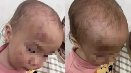 Ақтауда балабақшадағы бүлдіршіннің жарақаты жұртты шошытты