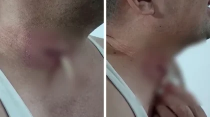 Ақтөбеде ота жасатқан ер адамның мойнында дәке қалып кеткен