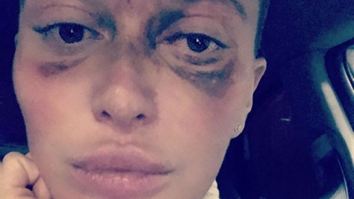 Девушка ослепла на один глаз после инъекции у косметолога в Москве